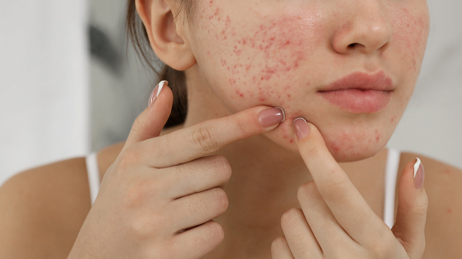 Healing Acne: How to Get Rid of Your Nemesis?